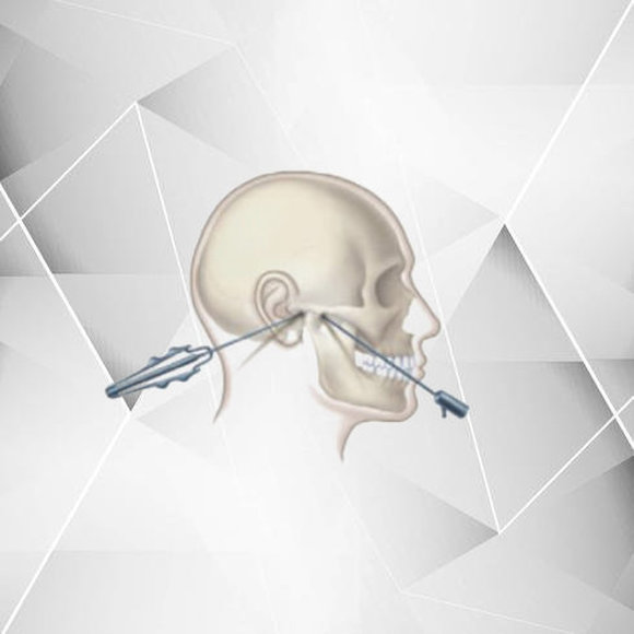 Cirurgia Artroscópica da Articulação temporomandibular (ATM)