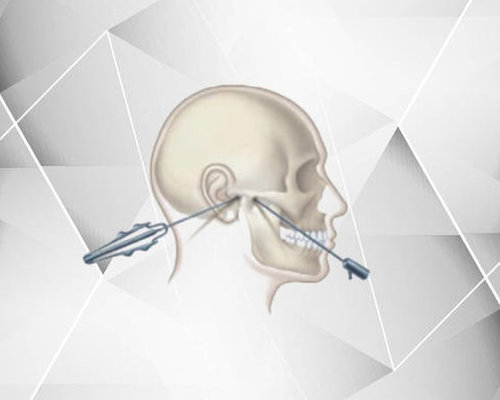 Cirurgia Artroscópica da Articulação temporomandibular (ATM)