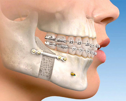 Cirurgia Ortognática